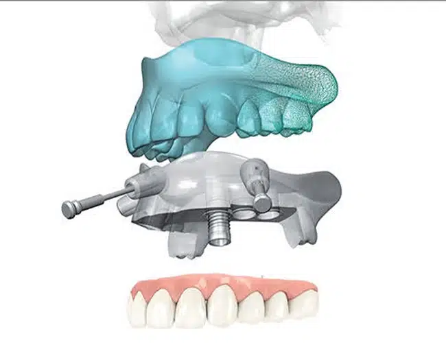 vegleges-hid-ala-implantacio